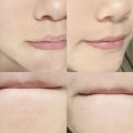 Ergonomic Blackhead Remover Stainless Steel Single/Dual-Ended Pore Cleaner Tool Comedone Extractor for Nose & Face. 