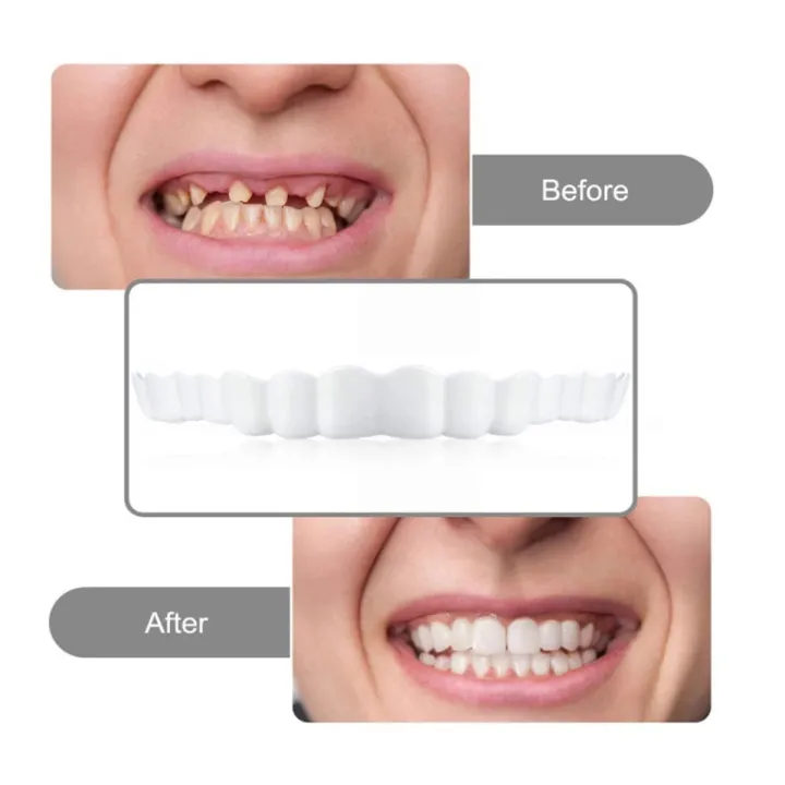 4%20pieces%20of%20white%20dentures%20-%20adjustable%20upper%20and%20lower%20dentures%20for%20men%20and%20women,%20comfortable%20fit%20and%20natural%20smile%20-%20Image%206