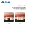 ELIJAH 200Pcs/Box Dental Fiber Post Drills Screw Straight Post Quartz Glass Thread Pile Kit Root Canal Restorative Materials. 