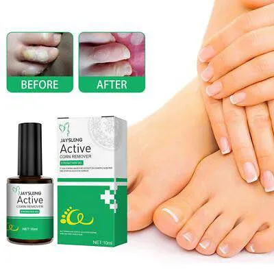 Jaysuing%20Active%20Corn%20Remover%20Gel%20%E2%80%93%2010ml%20Strong%20Formula%20for%20Effective%20Callus%20and%20Corn%20Removal%20-%20Image%202