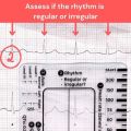 Ecg 7 Step Ruler 7 Step Scale For Ecg Observation Portable Transparent 7step Ruler Measurement Tool Ruler For Ecg Interpretation. 