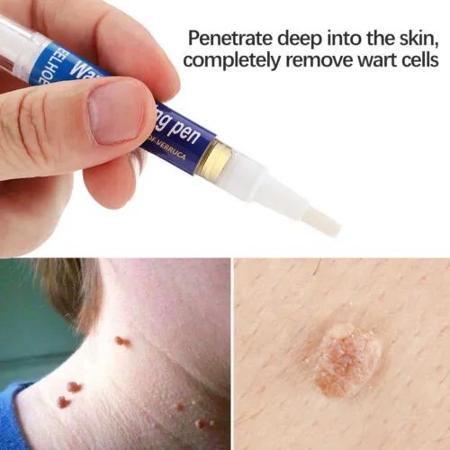 Quick%20Wart%20Removal%20Pen%20-%20Fast%20Acting,%20Safe%20Wart%20Removal%20Treatment%20%7C%20Effective%20Wart%20Removal%20Solution%20for%20Clear%20Skin%20%7C%20Eelhoe%20Skin%20Care%20for%20All%20Types%20of%20Warts%20-%20Image%207