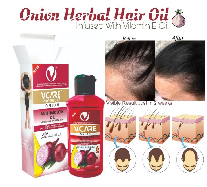 Onion Herbal Hair Oil 100ml By Vcare Best Hair Treatment Oil | Best Hair Fall Oil | Vitamin E blend Onion Oil
