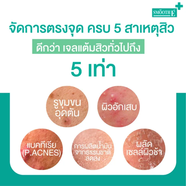 Smooth%20E%20acne%205%20Rapid%20Action%20anti%20acne%20hydrogel%20smooth%20e%20acne%205%20Rapid%20Action%20anti%20acne%20hydrogel%20%5B7G%5D%20anti-Acne%20Gel%20-%20Image%203