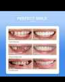 Snap On Veneers Teeth for Men and Women - Moldable False Teeth and Dentures Replacement Kit for Missing Teeth, with Teeth Grinding Guard, Best Whitening Strips and Fake Braces for Bad Teeth. 