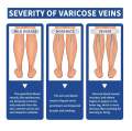 ointment for varicose veins Effective varicose vein relief cream to relieve Leg vasculitis phlebitis spider pain swelling Care. 