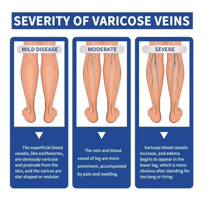 ointment%20for%20varicose%20veins%20Effective%20varicose%20vein%20relief%20cream%20to%20relieve%20Leg%20vasculitis%20phlebitis%20spider%20pain%20swelling%20Care%20-%20Image%203