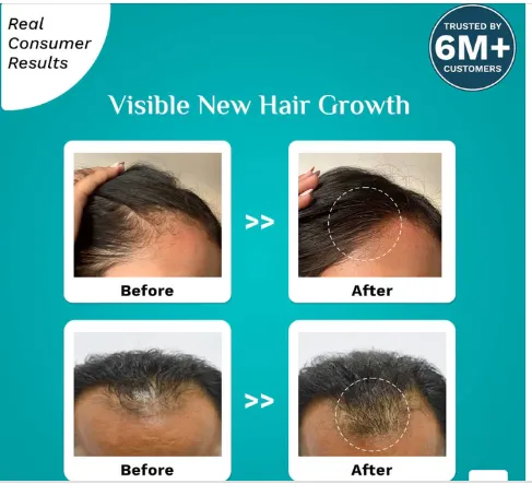 Pilgrim%203%25%20Redensyl%20+%204%25%20Anagain%20Hair%20Growth%20Serum%2030%20ml%20-%20Image%208