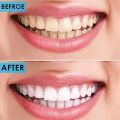 Tooth Dental Mirror for Mouth - Dentist Mirror Tool with Stainless Steel Handle - Oral Teeth Inspection Mirror - Dental Instruments (1). 