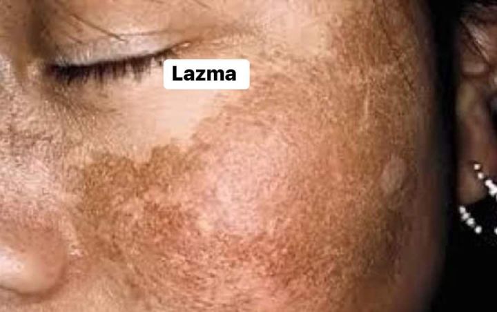 Lazma တင်းတိတ် မှဲ့ခြောက်ပျောက်ဆေး ( 30g )