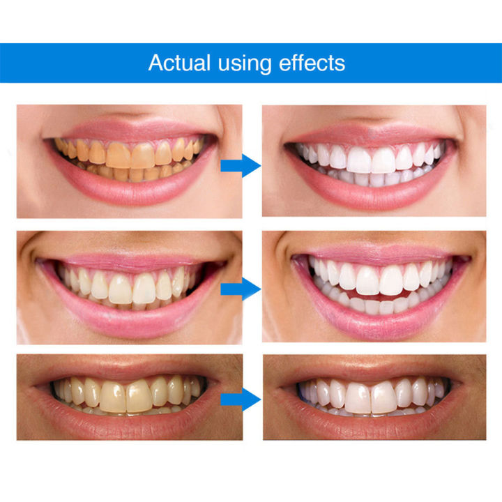 1-5PCS%204ml%20Teeth%20%20Pen%20Effective%20Painless%20Gum%20Therapy%20Gel%20Teeth%20%20Essence%20Pen%20No%20Sensitivity%20Teeth%20%20Gel%20-%20Image%204