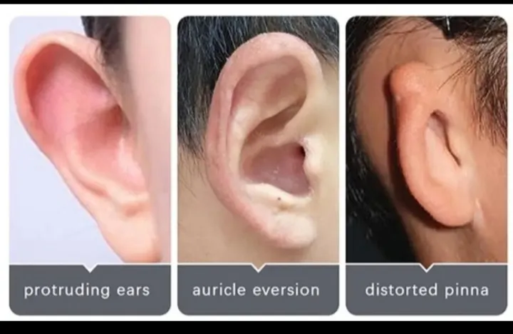 10%20Pcs%20Ear%20Corrector%20Sticker%20Stronger%20Ear%20Tape%20Patches%20Double%20sided%20Adhesive%20to%20Hold%20Back%20Protruding%20Ears%20-%20Image%207