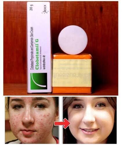 Clobetamil G Skin Soap and Cream Set