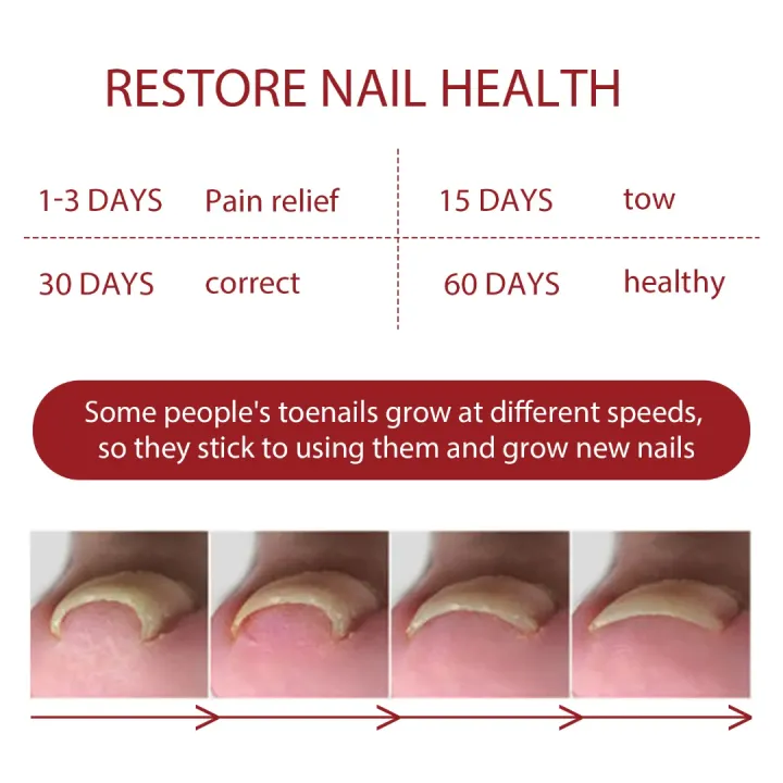German%20ToenailPlus%E2%84%A2%20Anti%20Paronychia%20Relief%20Oil%20-%2010ML%20-%20Image%204