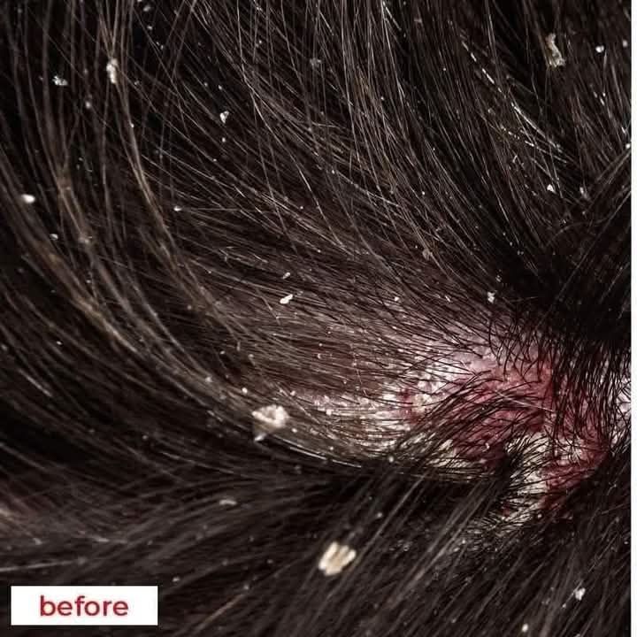 Nizoral%202%25%20Ketoconazole%20Hair%20Care%20Anti-Dandruff%20Shampoo%20100ml%20-%20Image%203