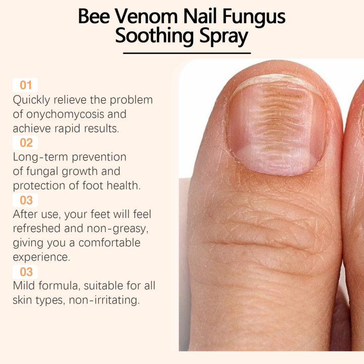 Anti%20Fungal%20Foot%20Spray%20Anti%20Beriberi%20Treatment%20Paronychia%20Onychomycosis%20Antibacterial%20Relieve%20Itching%20Feet%20Fungus%20Removal%20Spray%20freshfeet%20-%20Image%206