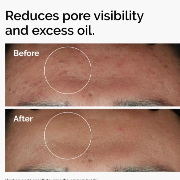 Niacinamide%2010%25%20+%20Zinc%201%25%20-%2030%20ml%20(2%20Layer%20Labeling)%20-%20Image%209