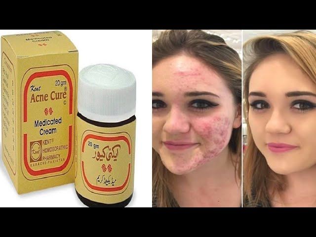 akni%20cure%20medicated%20cream%20-%20Image%202