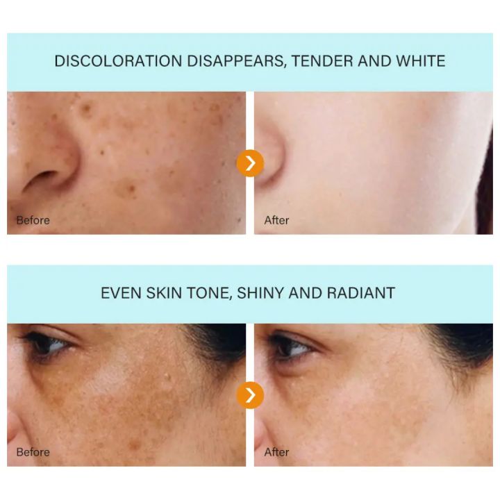 MOOYAM%20Dark%20Spot%20Removal%20Freckle%20Cream%2030g%20-%20Image%203