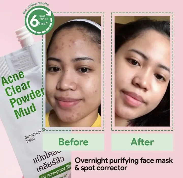 Oxecure%20Acne%20Clear%20Powder%20Mud%207g%20*Made%20in%20Thailand%20*%E1%80%9D%E1%80%80%E1%80%BA%E1%80%81%E1%80%BC%E1%80%B6%E1%80%90%E1%80%AD%E1%80%AF%E1%80%B7%E1%80%86%E1%80%B1%E1%80%B8%20*%E1%80%95%E1%80%BC%E1%80%94%E1%80%BA%E1%80%95%E1%80%AD%E1%80%90%E1%80%BA%E1%80%91%E1%80%AC%E1%80%B8%E1%81%8D%E1%80%9B%E1%80%9E%E1%80%B1%E1%80%AC%20%E1%80%A1%E1%80%96%E1%80%AF%E1%80%B6%E1%80%B8%E1%80%95%E1%80%AB%20Travel%20pack%20%E1%80%A1%E1%80%91%E1%80%AF%E1%80%95%E1%80%BA%E1%80%96%E1%80%BC%E1%80%85%E1%80%BA%E1%80%95%E1%80%AB%E1%80%9E%E1%80%8A%E1%80%BA%20*Exp%20Date:%202023%20-%20Image%202