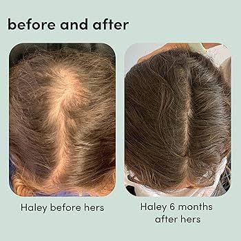 Minoxidil%205%25%20Hair%20Topical%20Solution%20Hairfall%20Solution%20Hair%20Regrowth%20-%20Minoxin%20spray%20-%20Image%202
