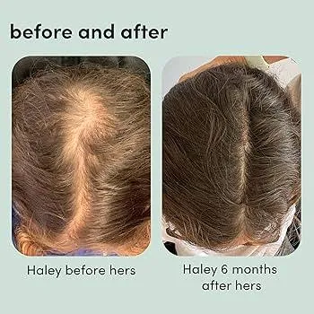 Minoxidil%205%25%20Hair%20Topical%20Solution%20Hairfall%20Solution%20Hair%20Regrowth%20-%20Minoxin%20spray%20-%20Image%202