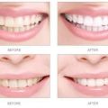 Xpert tooth whitening Drops Polish. 