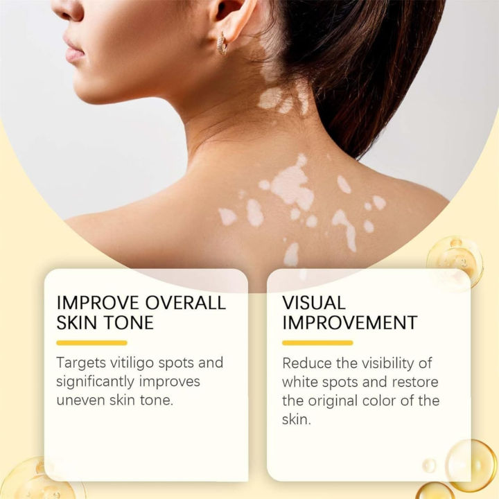 Original%20Vitigo%20Bee%20Venom%20Care%20Cream%20for%20Vitiligo,%20Pigmentation%20&%20White%20Spots%20%7C%20Skin%20Repair%20&%20Melanin%20Restoration%20Cream%20%7C%20Natural%20Herbal%20Treatment%20for%20Uneven%20Skin%20Tone%20%7C%20Moisturizing%20Anti-Spot%20Whitening%20Cream%20%E2%80%93%2020g%20%7C%20Gadget%20Xpres%20-%20Image%207