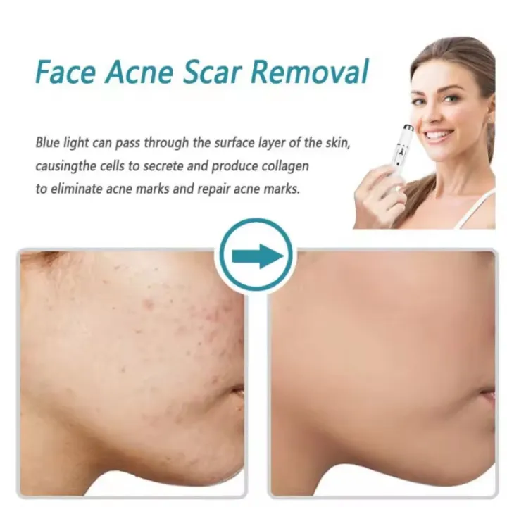 Acne%20Wrinkle%20Removal%20Laser%20Pen%20Skin%20Spots%20Removal%20Anti%20Varicose%20Spider%20Vein%20Treatment%20Medical%20Blue%20Light%20Eye%20Treatment%20Instrumen%20-%20Image%203