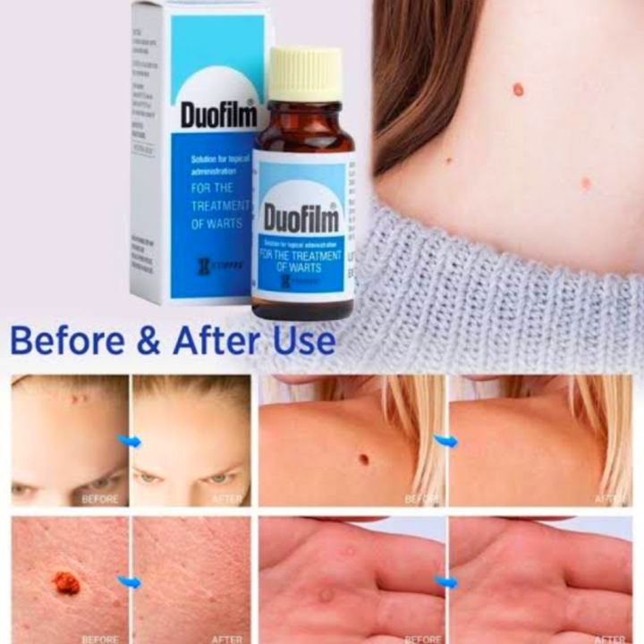 Wart Remover Doufilm Lotion 15ml