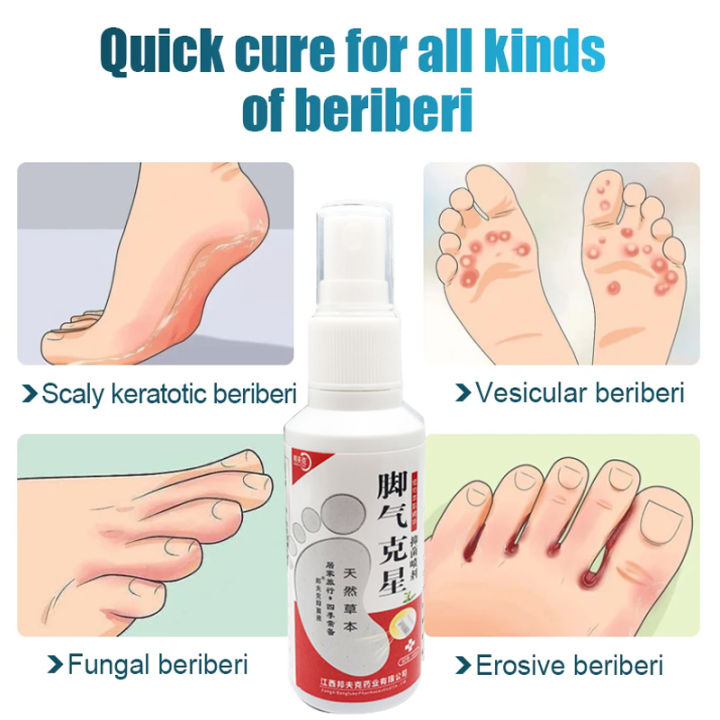 1Pcs%20Anti%20Fungal%20Foot%20Spray%20Foot%20Odor%20Remover%20Athlete%20Foot%20Medical%20Liquid%20Eczema%20Itching%20Onychomycosis%20Treatment%20Foot%20Care%20freshfeet%20-%20Image%204
