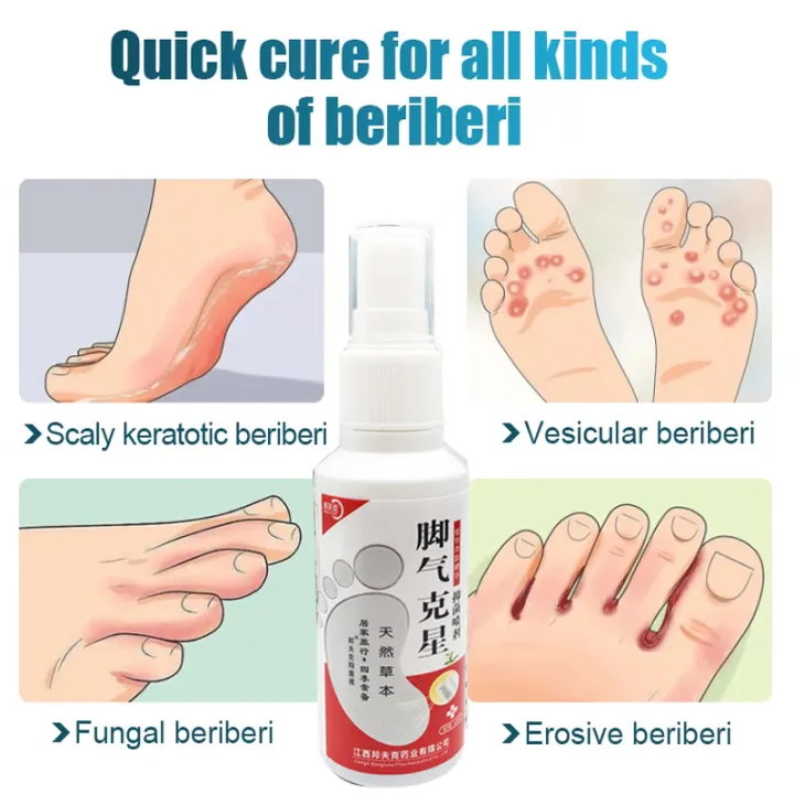1Pcs%20Anti%20Fungal%20Foot%20Spray%20Foot%20Odor%20Remover%20Athlete%20Foot%20Medical%20Liquid%20Eczema%20Itching%20Onychomycosis%20Treatment%20Foot%20Care%20freshfeet%20-%20Image%204