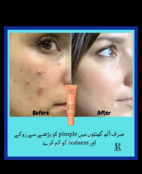 oriflame%20Pure%20skin%20facewash,%20Sos%20gel%20acne%20treatment,%20for%20oily%20skin%20,remove%20acne,acne%20spots,scars%20women%20accessories%20-%20Image%205