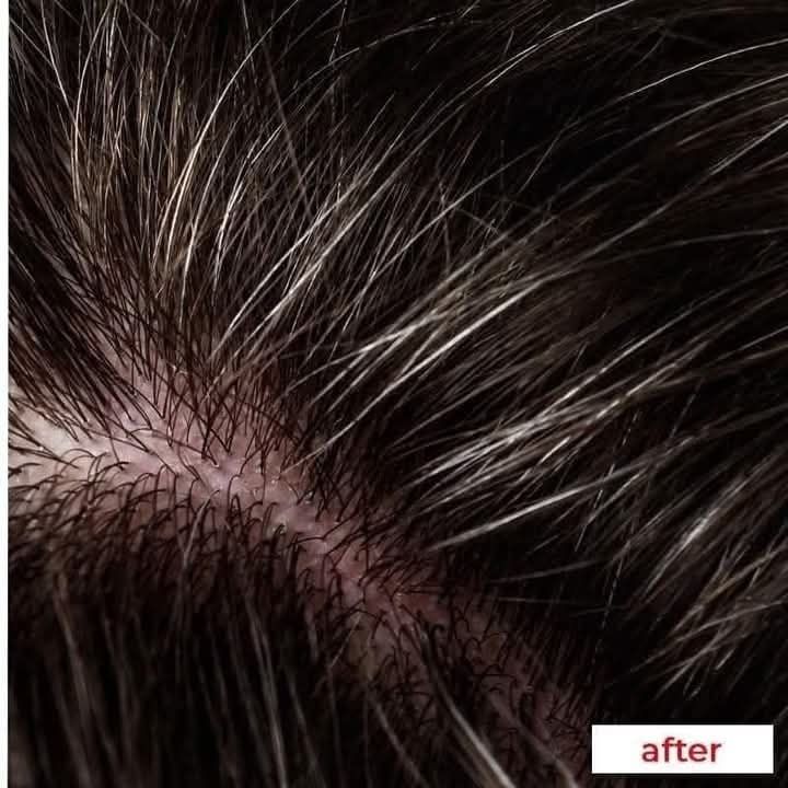 Nizoral%202%25%20Ketoconazole%20Hair%20Care%20Anti-Dandruff%20Shampoo%20100ml%20-%20Image%204