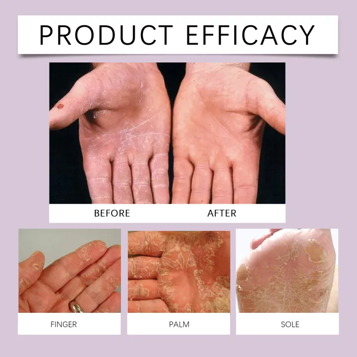 10%25%20Urea%20Foot%20Cream%20Stick%20Moisturizing%20&%20Exfoliating,%20Cracked%20Heel%20Repair%20Deep%20Hydration%20for%20Dry%20Feet%20Long%20Protection%20Hand%20Cream%20-%20Image%203