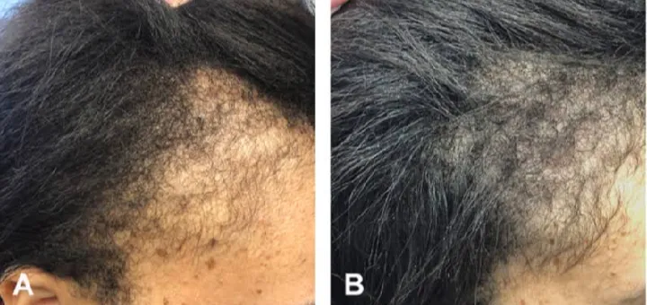 Minoxin%20Plus%20Topical%20Hair%20Regrowth%20Solution%20(Minoxidil%205%25),%2060ml%20-%20Brookes%20Pharma%20-%20Image%204