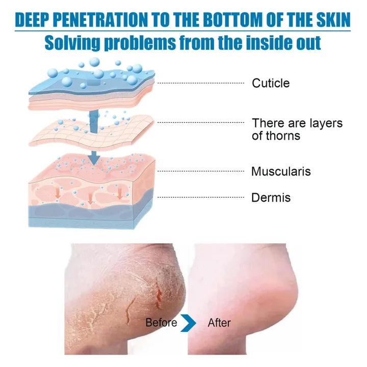 1-10%20Pairs%20Exfoliating%20Callus%20Booties%20Feet%20Care%20Foot%20Mask%20Sheet%20Pack%20Nourish%20Smooth%20Moisturizing%20Foot%20Spa%20Skin%20Care%20for%20Feet%20-%20Image%205