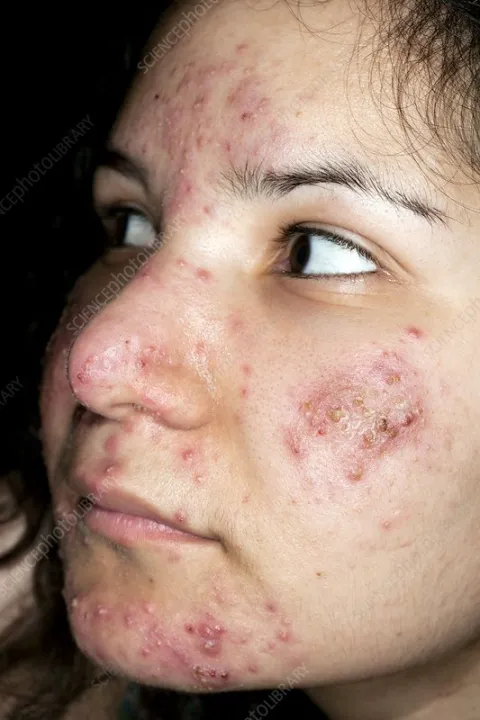 T3%20mycin%20lotion%20-%20Image%206