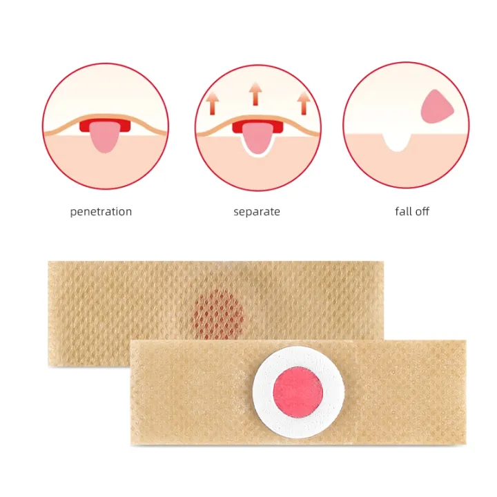 6PCS Foot Care Sticker Patch Corn Removal Pads Curative Patches ...
