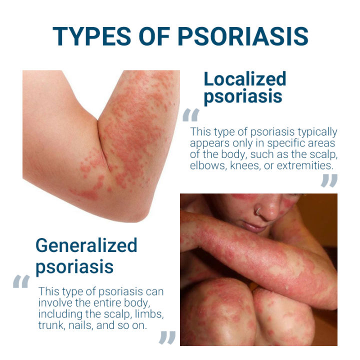 C%C3%A8raV%C3%A8%20Cleanser%20for%20Psoriasis%20Treatment%20Itch%20Relief%20&%20Exfoliation%20237ML%20-%20Image%205