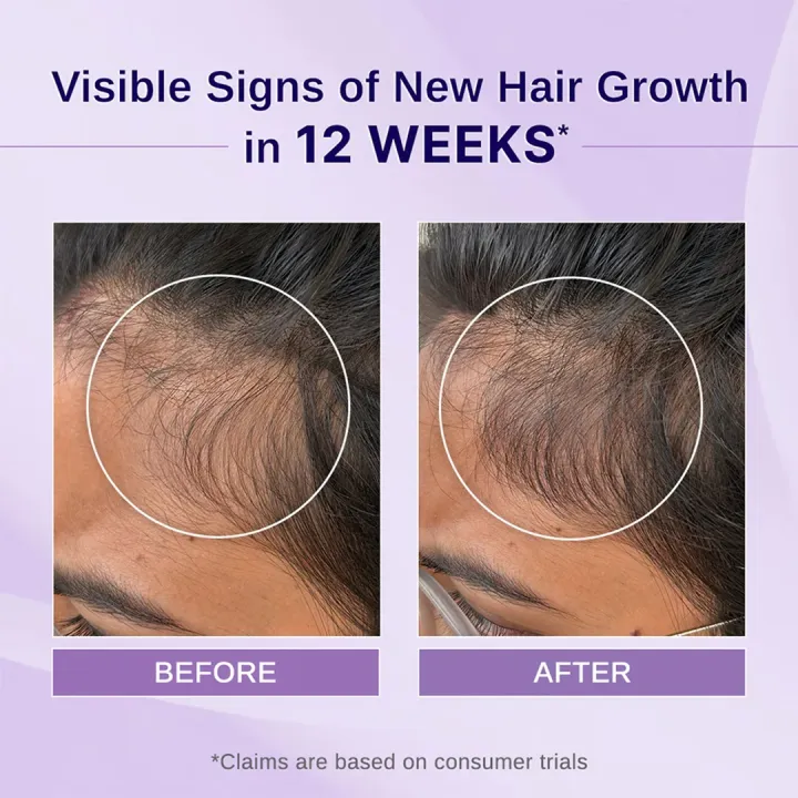 BARE%20ANATOMY%20Rosemary%20&%20Hibiscus%20Hair%20Growth%20Oil%20enriched%20with%20Bhringraj%20for%20New%20Hair%20Growth%20Hair%20Oil%20(100%20ml)%20-%20Image%202