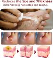 South moon Foot Corn Removal Extra Strengthen Gel 10ml.