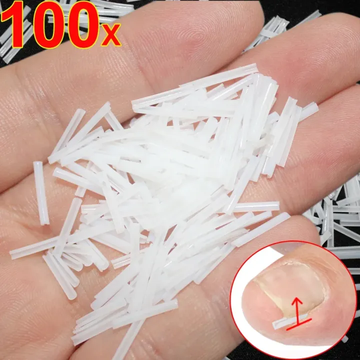 1-100PCS%20Ingrown%20Toenail%20Correction%20Ultra-thin%20Nail%20Treatment%20Elastic%20Patch%20Sticker%20Straightening%20Nails%20Groove%20Ingrown%20Corrector%20-%20Image%206