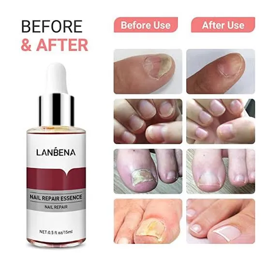 LANBENA%20Nail%20Repair%20Essence%20-%2015ml%20-%20Image%205