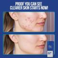 Wiki Special Anti Acne Serum 30ml | Clears Acne & Soothes Skin. 