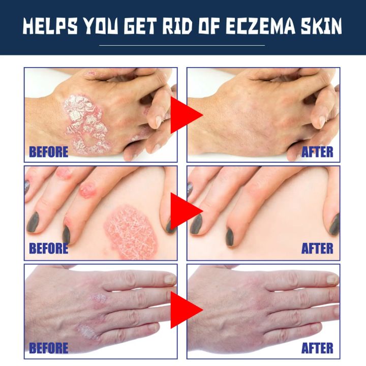 South%20Moon%20Psoriasis%20Relief%20Spray%20Net:%2030ml%20-%20Image%202