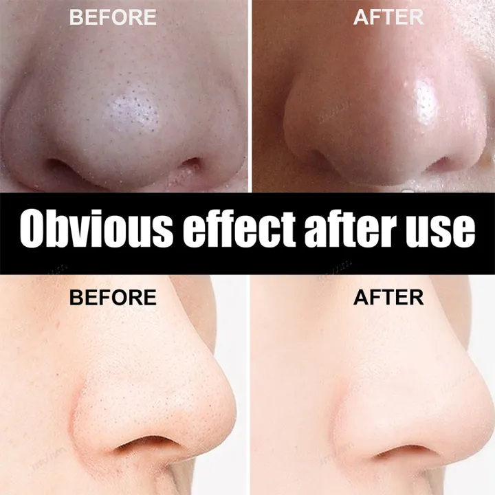 Unisex%20Blackhead%20Remove%20Mask%20Peel%20Nasal%20Strips%20Deep%20Shrink%20Cleansing%20Pore%20Nose%20Black%20Head%20Remove%20Stickers%20Skin%20Care%20Mask%20Patch%20-%20Image%203