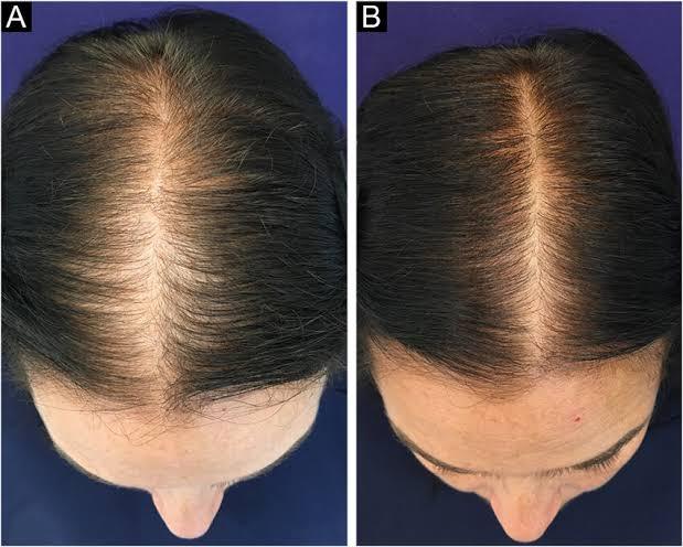 Minoxidil%205%25%20Hair%20Topical%20Solution%20Hairfall%20Solution%20Hair%20Regrowth%20-%20Minoxin%20spray%20-%20Image%205