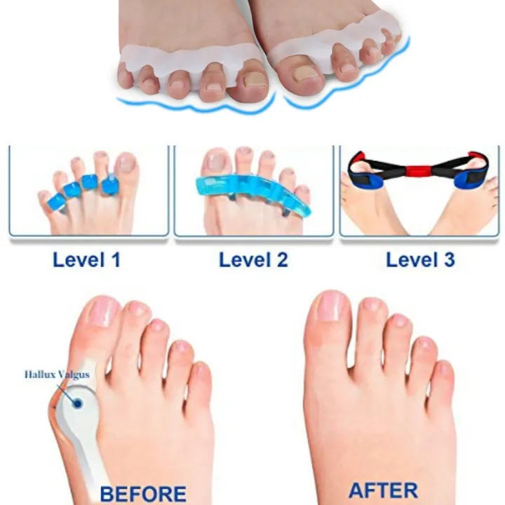 2pcs=%201%20Pair%20Soft%20Silicone%20Bunion%20Toe%20Corrector%20Nail%20Protector%20Foot%20Skin%20Care%20Tool%20Toe%20Hallux%20Valgus%20Straightener%20Spreader%20-%20Image%202