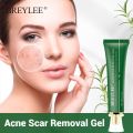 Breylee acne treatment set 4pcs(facial cleanser,acne Gel,serum ,cream. 